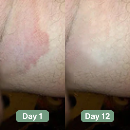 Veloma Rapid Jock Itch Relief Soap