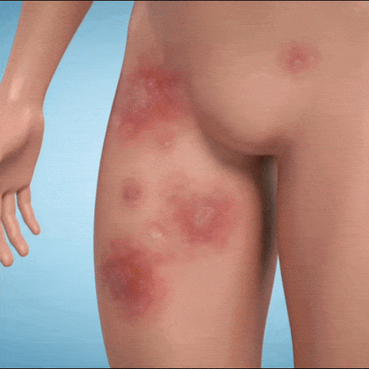 Veloma Rapid Jock Itch Relief Soap
